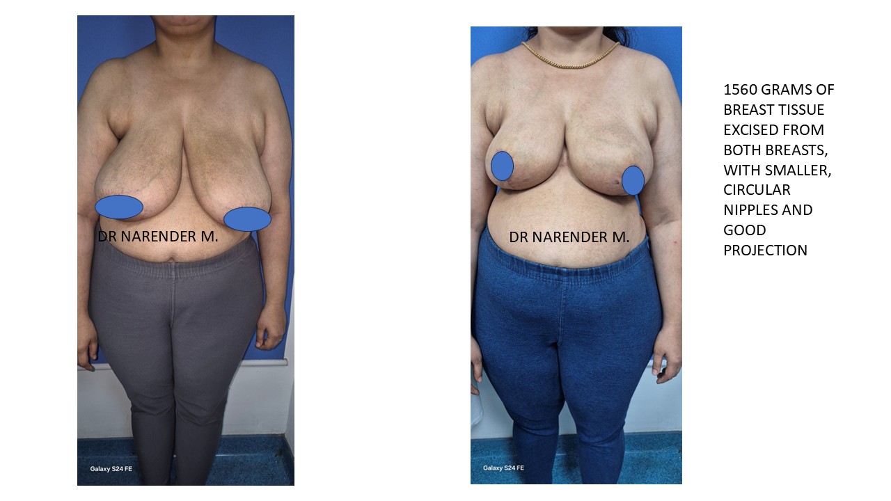 Breast Reconstruction Photo 4